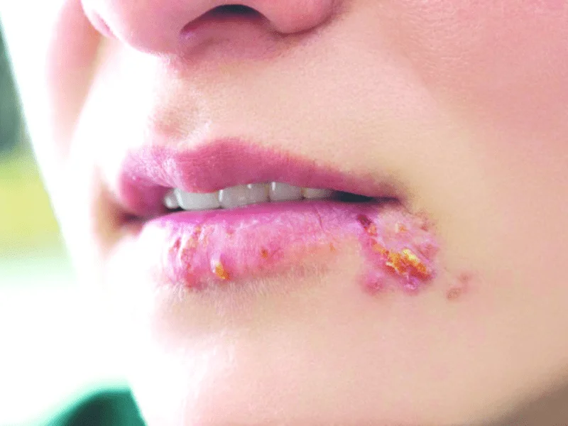 Loét da ở vùng miệng hay bị lầm là mụn quanh miệng