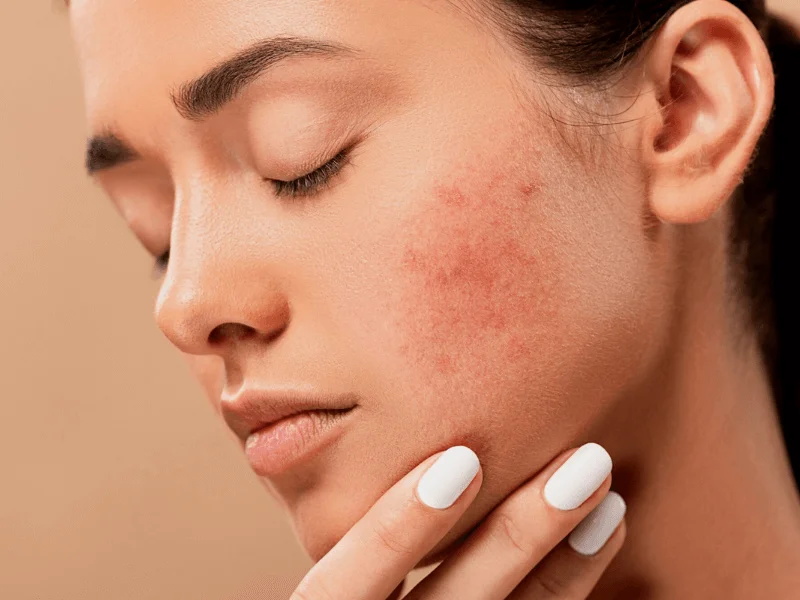 Khi điều trị mụn ẩn dưới da không dứt điểm hoặc còn sót nhân mụn dưới da, bạn rất có nguy cơ bùng phát mụn trở lại