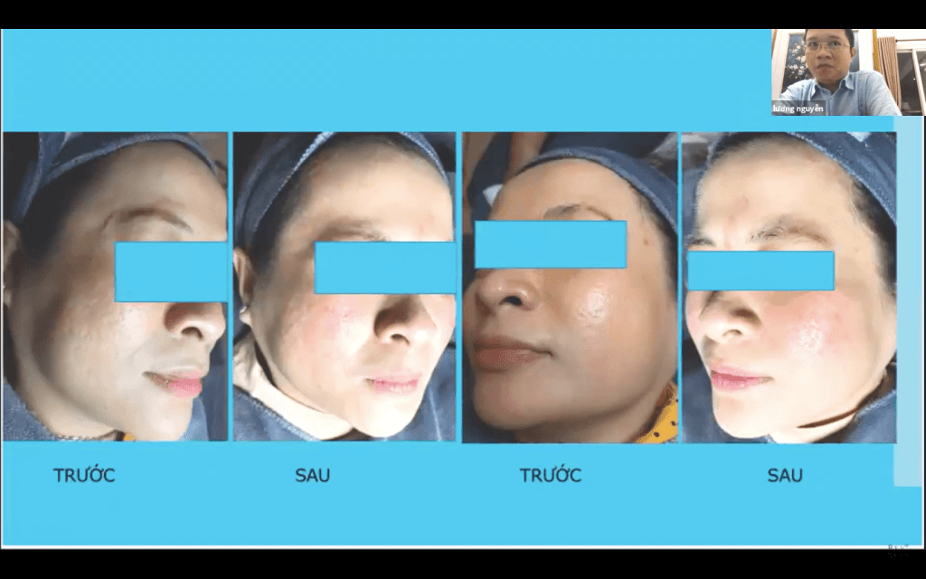 WORSHOP ĐIỀU TRỊ SẸO RỖ & KINH NGHIỆM TỒN TẠI QUA KHỦNG HOẢNG MÙA DỊCH workshop dieu tri seo ro va khung hoang mua dich 2