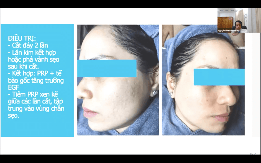 WORSHOP ĐIỀU TRỊ SẸO RỖ & KINH NGHIỆM TỒN TẠI QUA KHỦNG HOẢNG MÙA DỊCH Phận loại từng loại mụn cùng với những phương pháp điều trị phù hợp