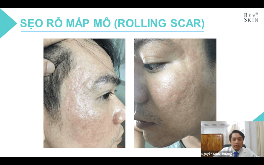 WORSHOP ĐIỀU TRỊ SẸO RỖ & KINH NGHIỆM TỒN TẠI QUA KHỦNG HOẢNG MÙA DỊCH Phận loại từng loại mụn cùng với những phương pháp điều trị phù hợp