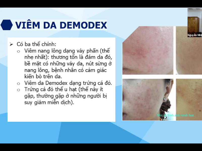 WORKSHOP TRỊ MỤN CHUYÊN CUNG CẤP PHÁC ĐỒ ĐIỀU TRỊ MỤN MỚI NHẤT workshop tri mun 2