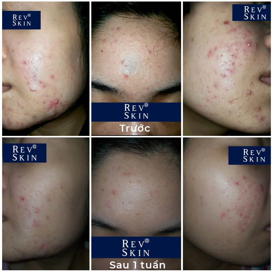So sánh làn da trước và sau sử dụng RevSkin Acne Cream