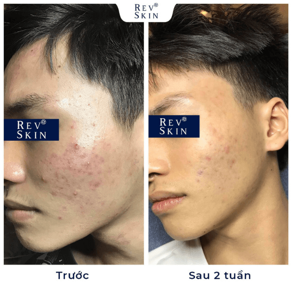 tri mun tai nha voi kem cham mun revskin
