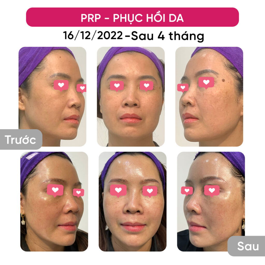 Chuyển giao công nghệ Revskin