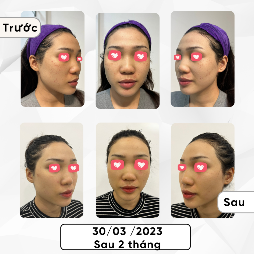 Chuyển giao công nghệ Revskin