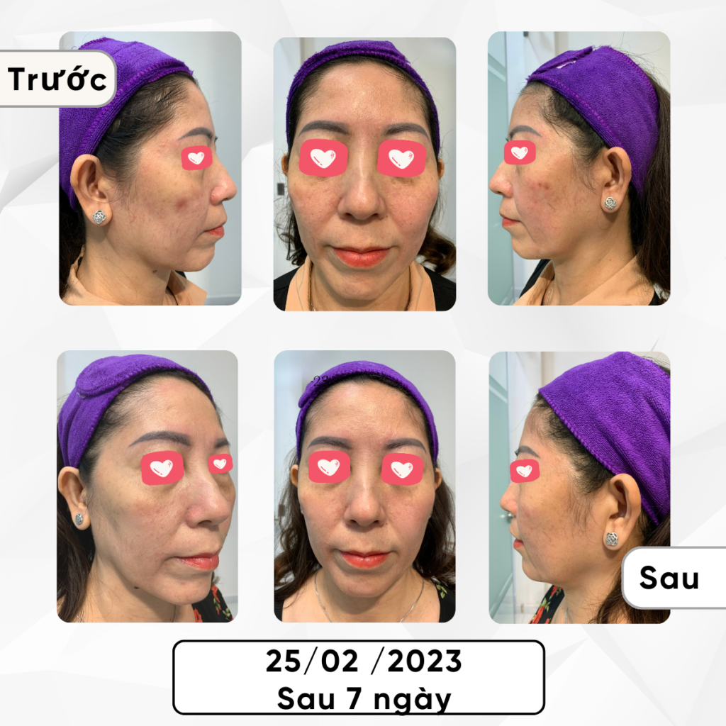Chuyển giao công nghệ Revskin