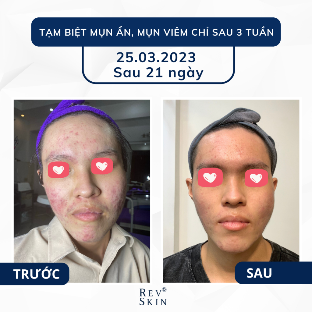 Chuyển giao công nghệ Revskin