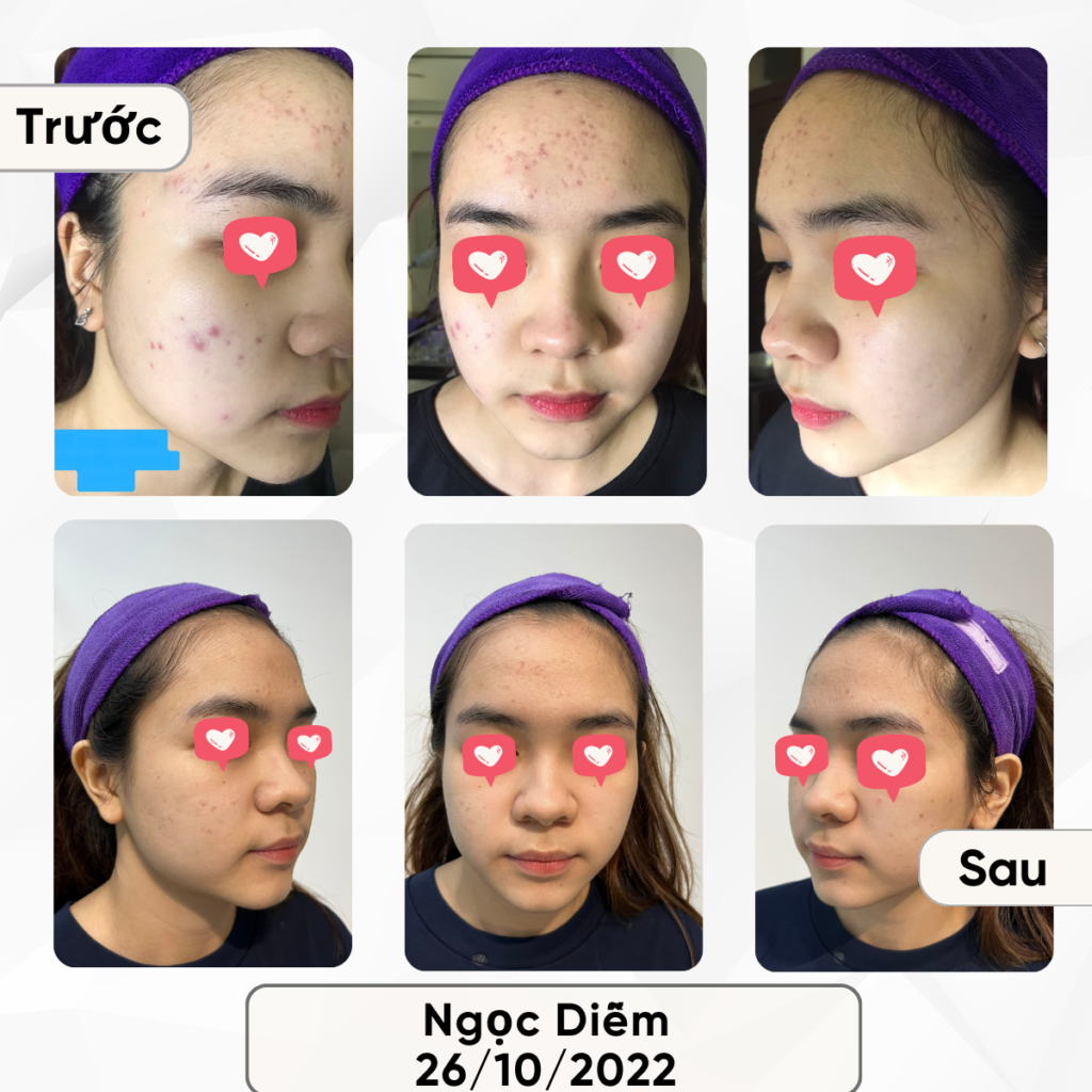 Chuyển giao công nghệ Revskin
