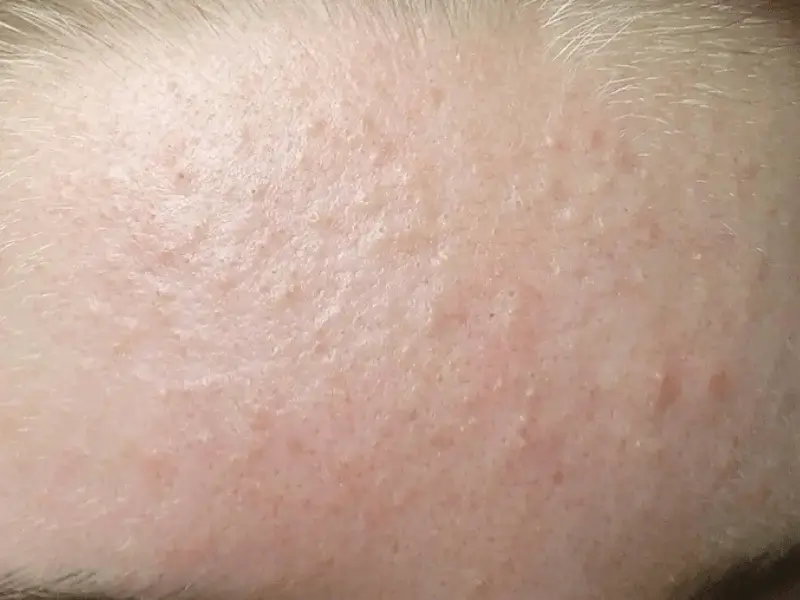 Chuyển giao công nghệ Revskin