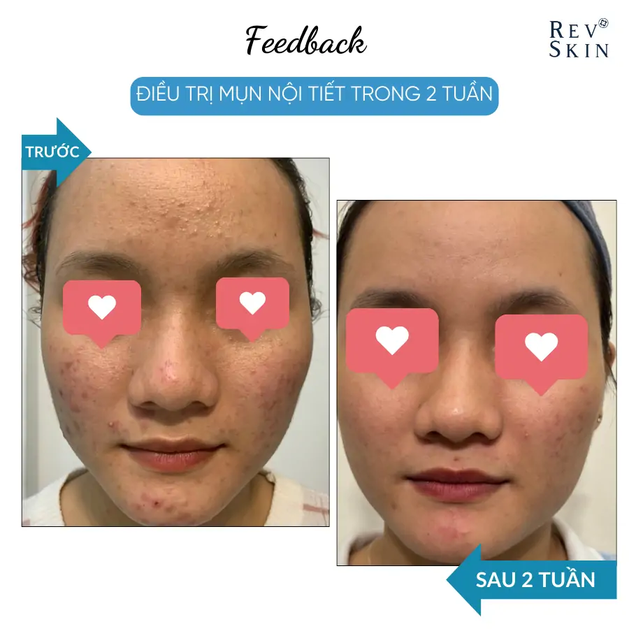 Combo Trị Mụn RevSkin Deep Cleanser & RevSkin Acne Cream dieu tri seo 8