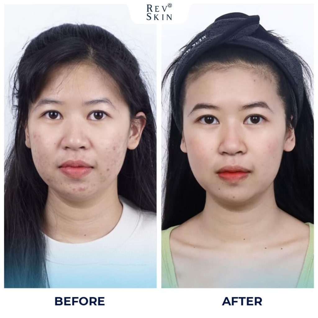 Chuyển giao công nghệ Revskin