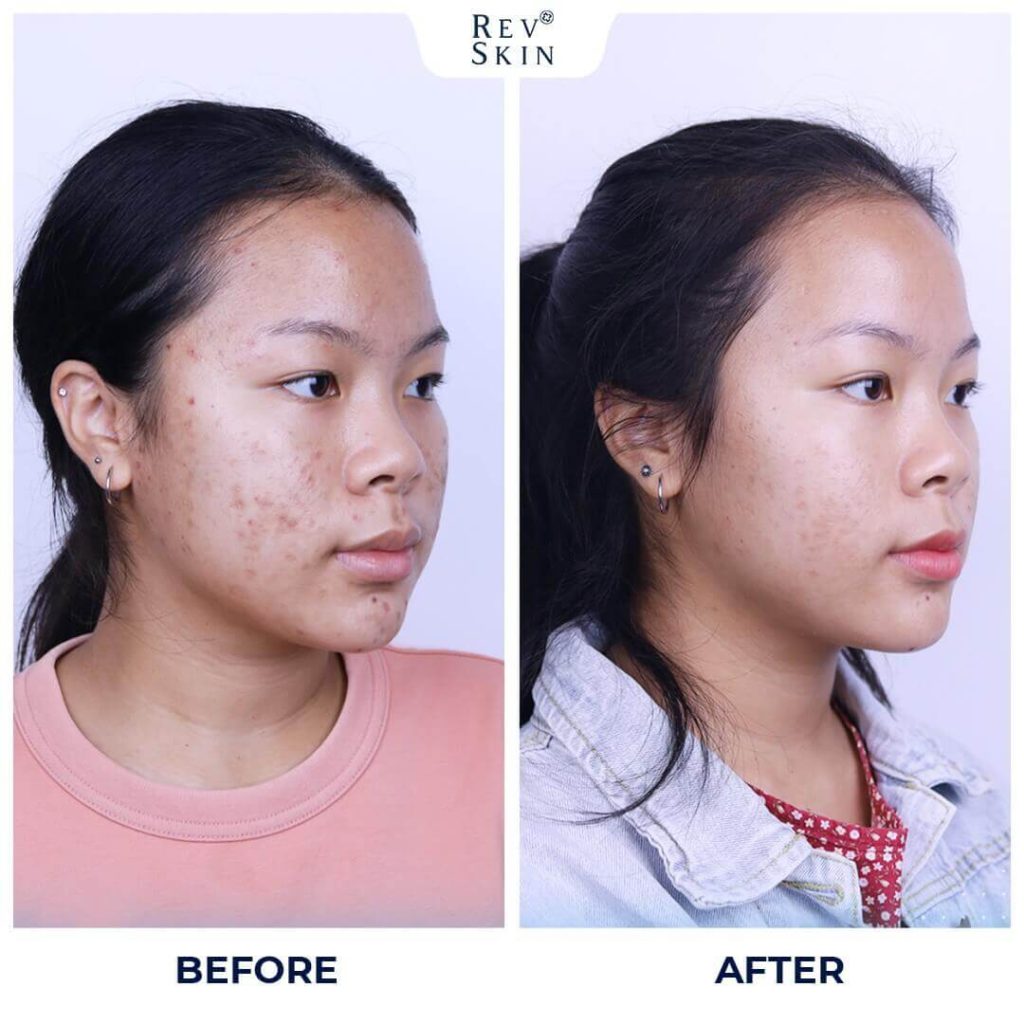 Chuyển giao công nghệ Revskin
