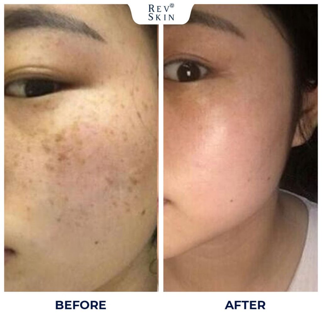 Chuyển giao công nghệ Revskin