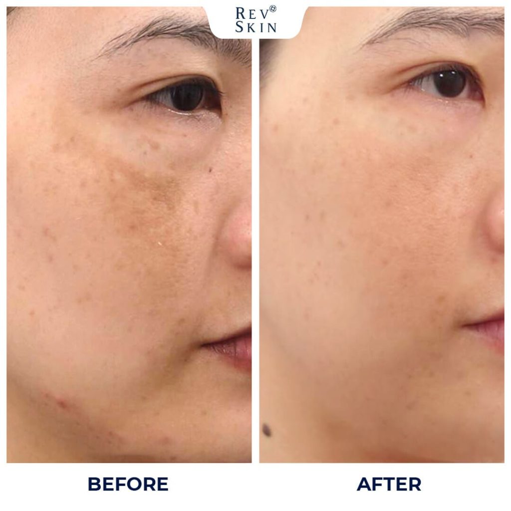 Chuyển giao công nghệ Revskin