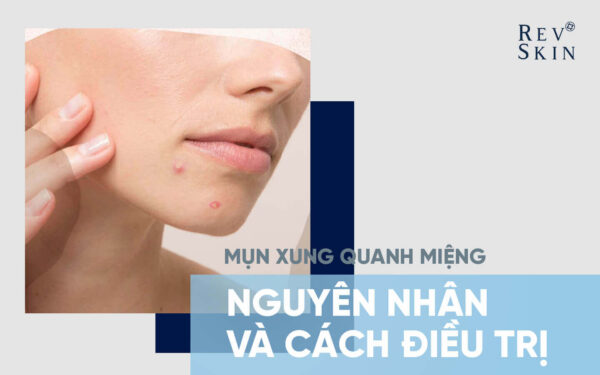 Nguyên nhân và cách điều trị mụn xung quanh miệng