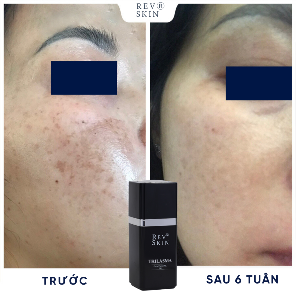 Chuyển giao công nghệ Revskin