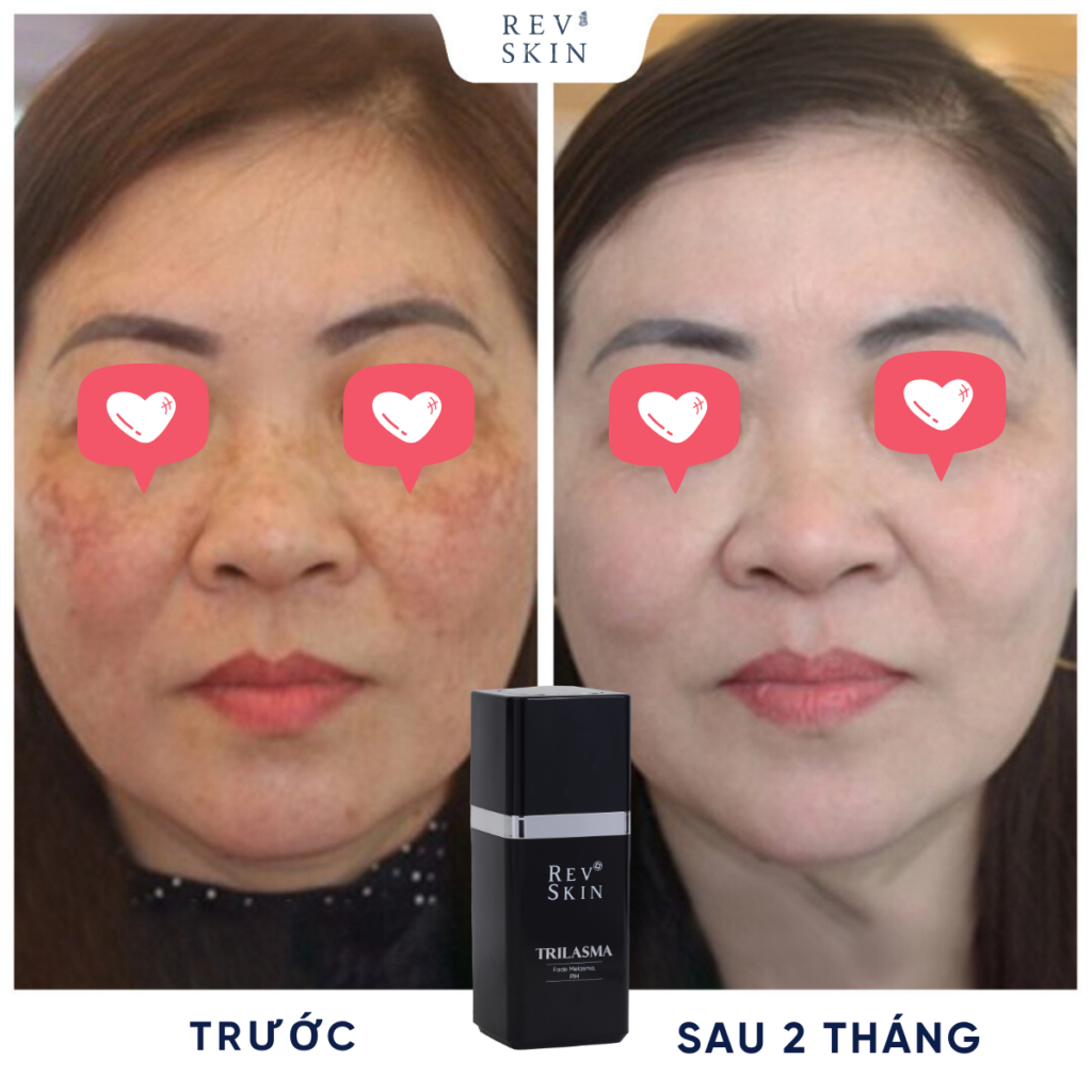 Chuyển giao công nghệ Revskin
