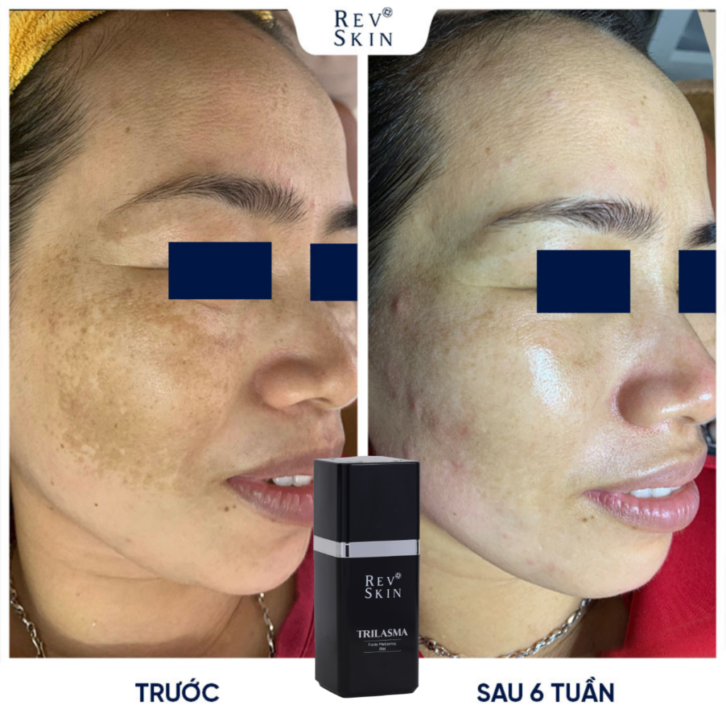 Chuyển giao công nghệ Revskin