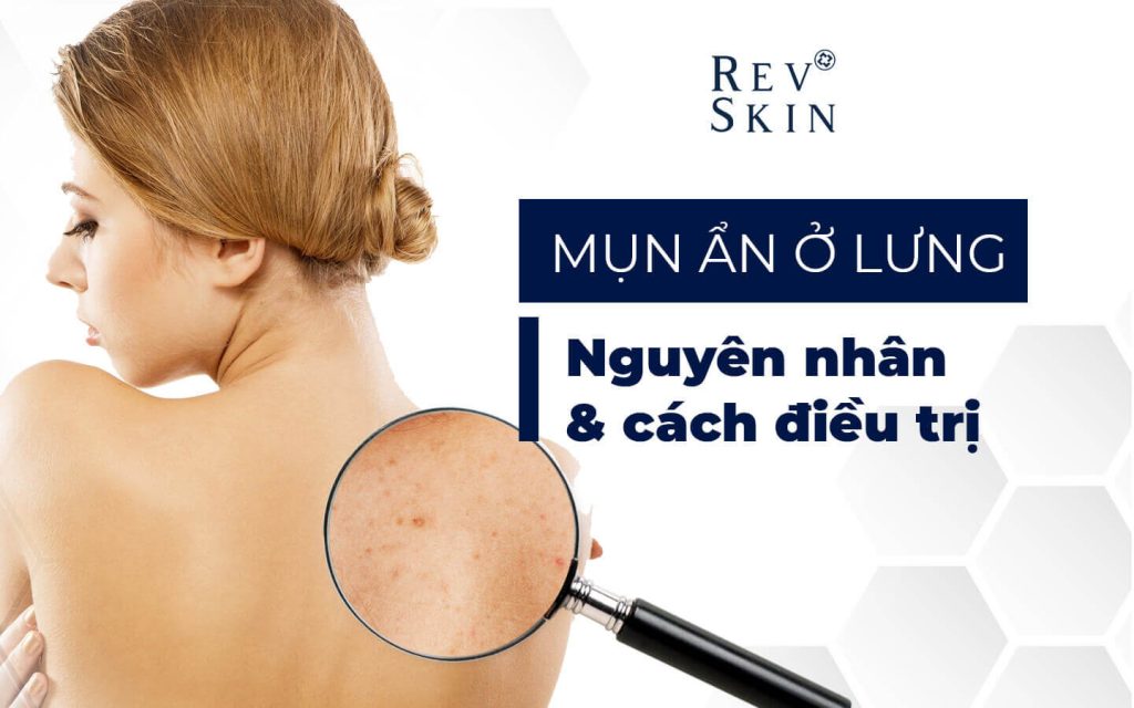 Chuyển giao công nghệ Revskin