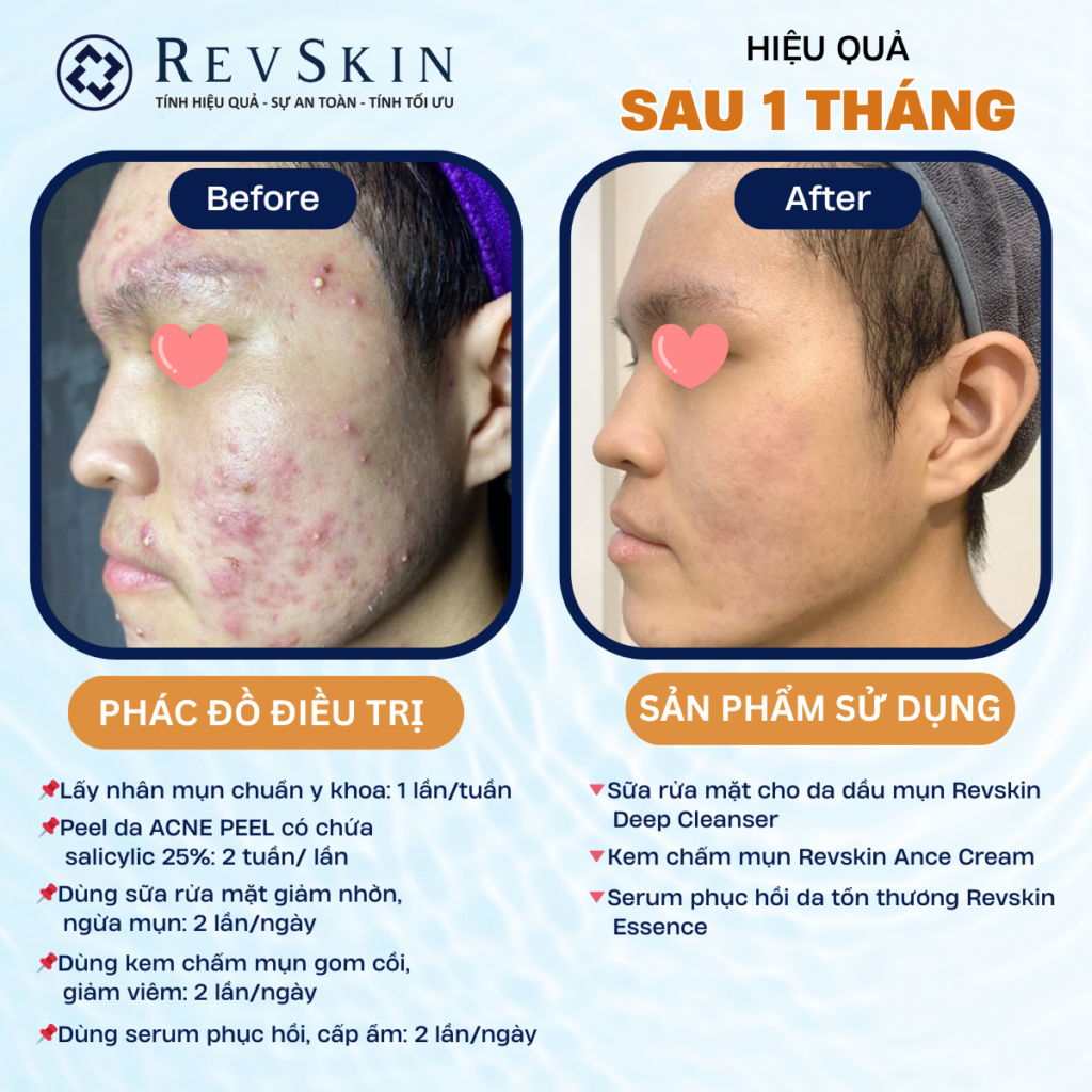 Chuyển giao công nghệ Revskin