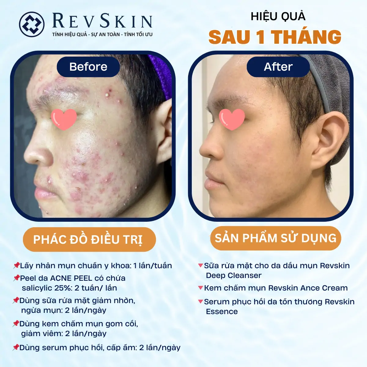 Combo Trị Mụn RevSkin Deep Cleanser & RevSkin Acne Cream noi dung doan van ban cua ban 16