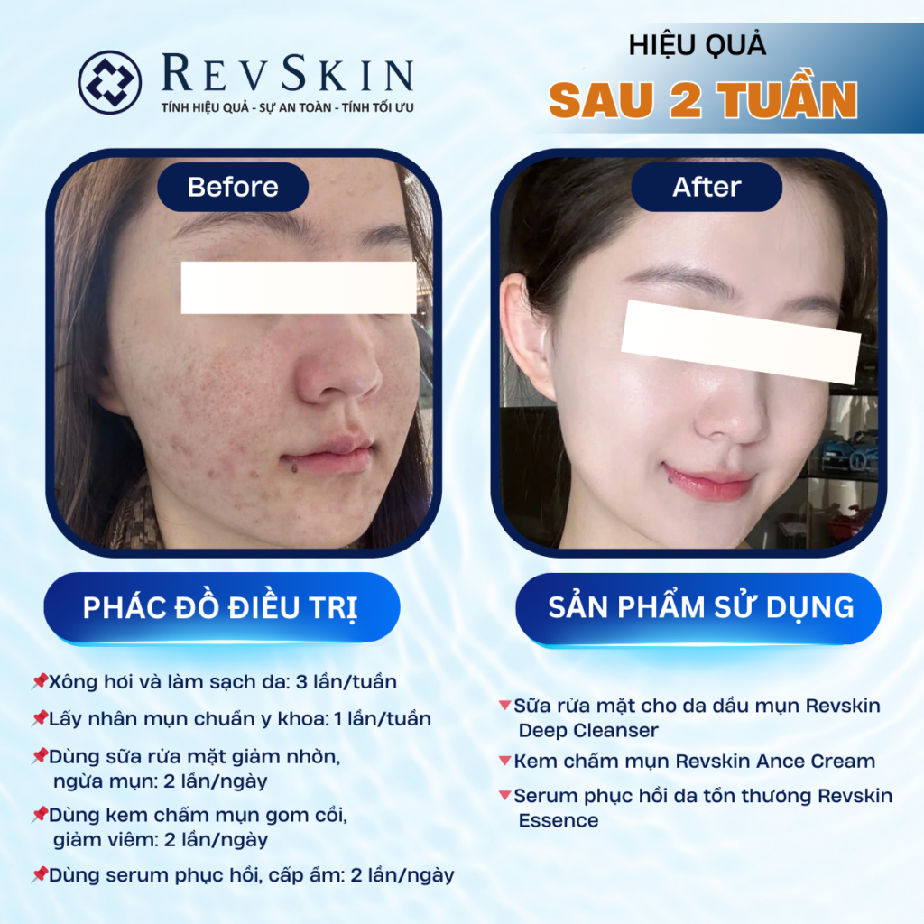 Chuyển giao công nghệ Revskin