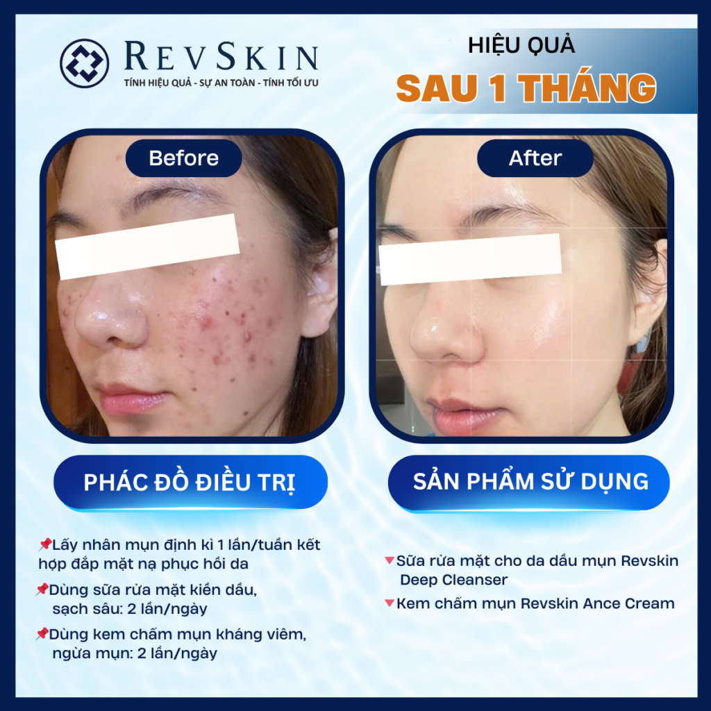 Chuyển giao công nghệ Revskin