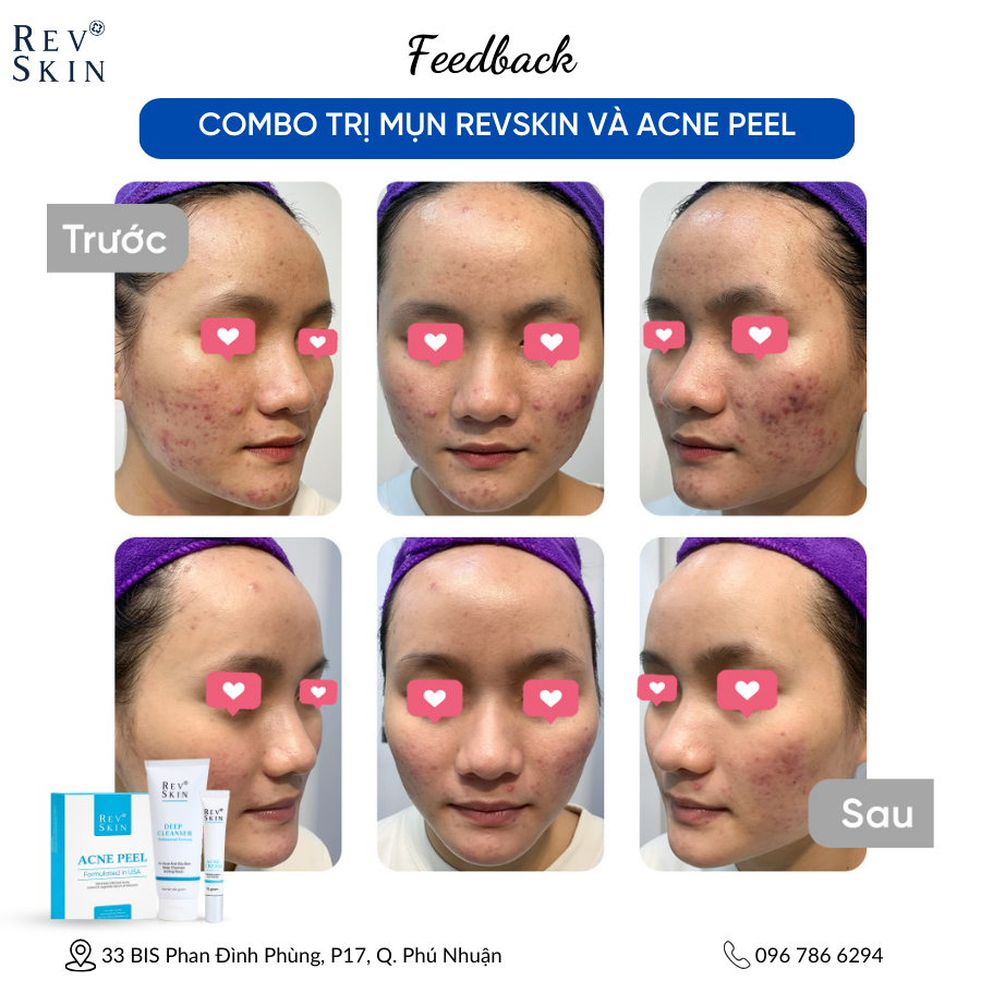 Chuyển giao công nghệ Revskin