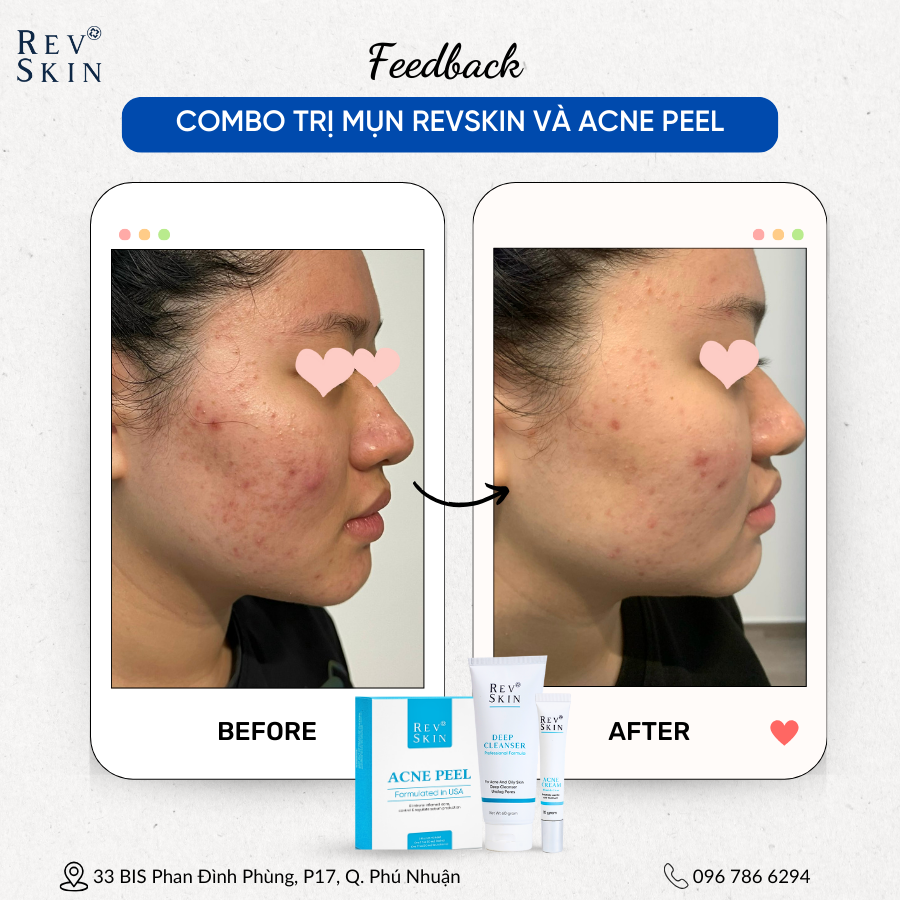 Chuyển giao công nghệ Revskin