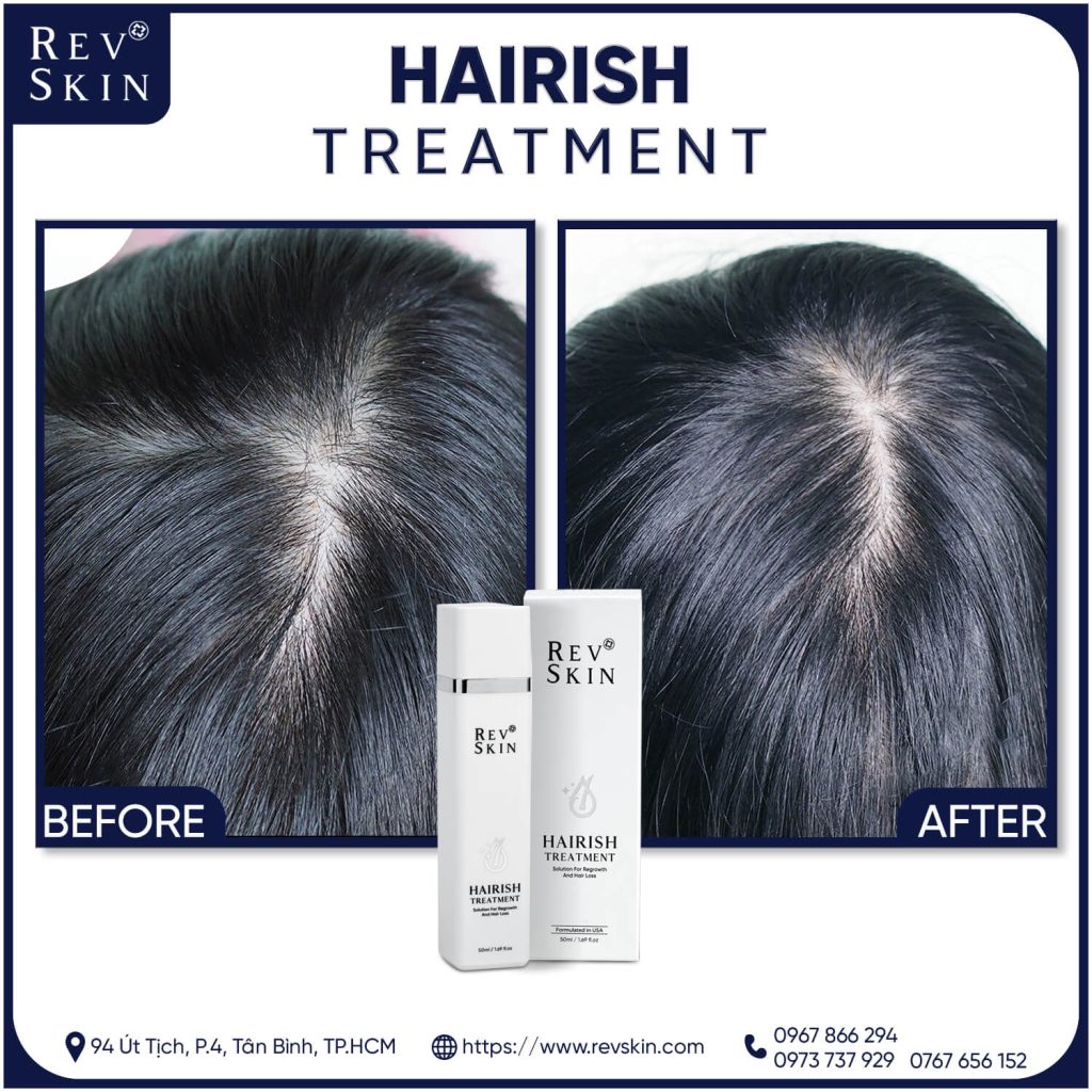 Chuyển giao công nghệ Revskin