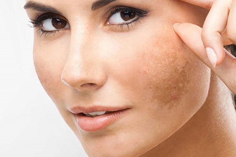 Nám da là tình trạng xuất hiện phổ biến ở phụ nữ