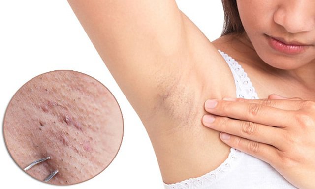 Việc gây tổn thương cho da cũng dẫn tới tình trạng thâm nách