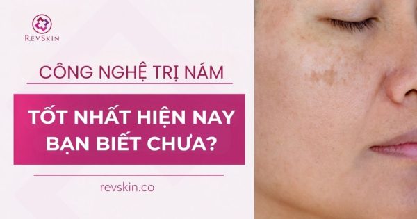 công nghệ điều trị nám tốt nhất hiện nay