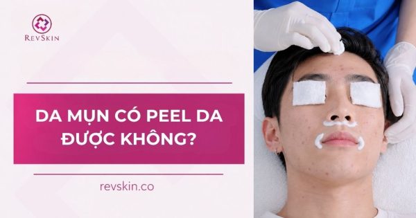 da mụn có peel da được không