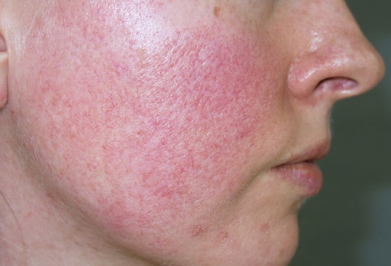 Peel da bị đỏ và những điều chưa biết Da thường bị đỏ sau khi peel