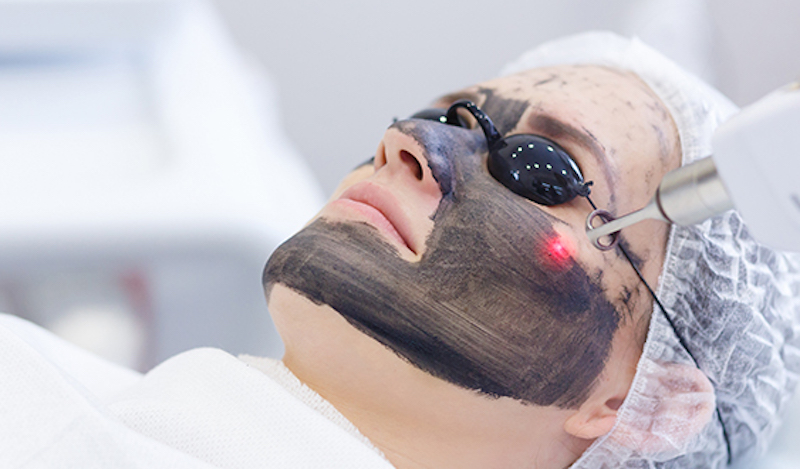Peel da trị sẹo rỗ mang lại cơ hội mới Peel da laser là phương pháp điều trị sẹo rỗ được ưa chuộng vì hiệu quả cao