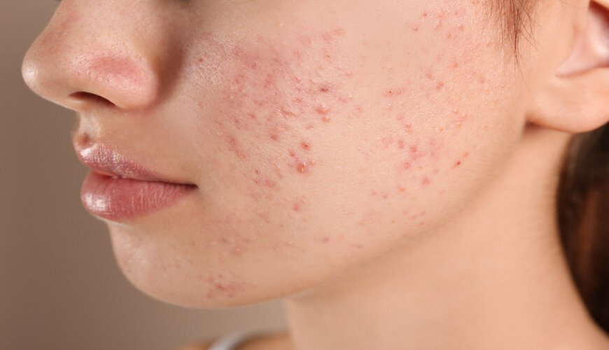 Chuyển giao công nghệ Revskin