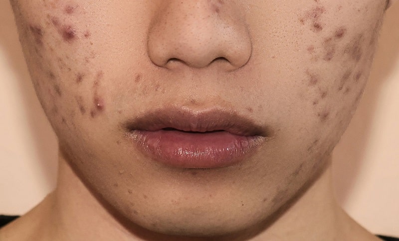 Chuyển giao công nghệ Revskin