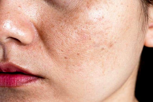Chuyển giao công nghệ Revskin