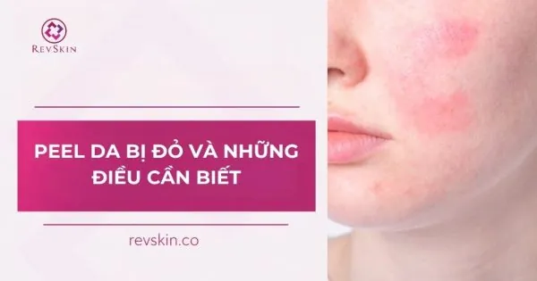 peel da bị đỏ và những điều cần biết