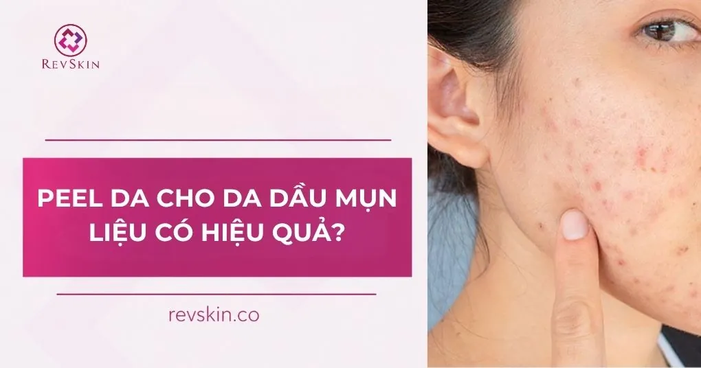 Peel da cho da dầu mụn liệu có hiệu quả? peel da cho da dầu mụn liệu có hiệu quả