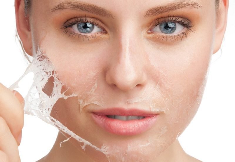 Da mụn có peel da được không? Peel da là phương pháp điều trị và chăm sóc da hiệu quả
