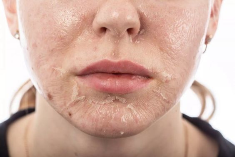 Peel da trị nám và những điều cần biết peel da se giup xu ly va cai thien cac tinh trang nam va khong deu mau