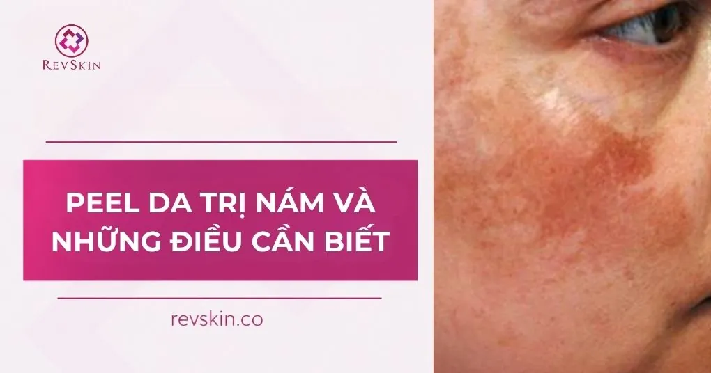 Peel da trị nám và những điều cần biết peel da trị nám và những điều cần biết