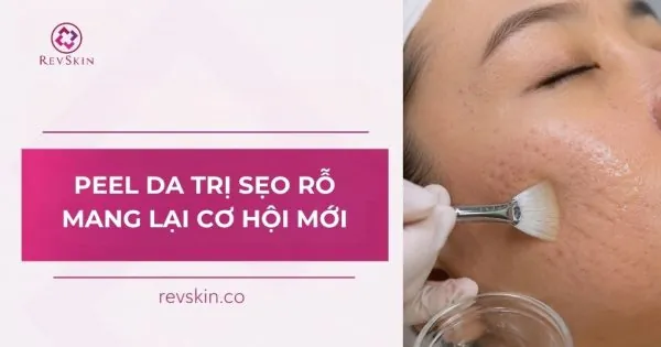 peel da trị sẹo rỗ mang lại cơ hội mới