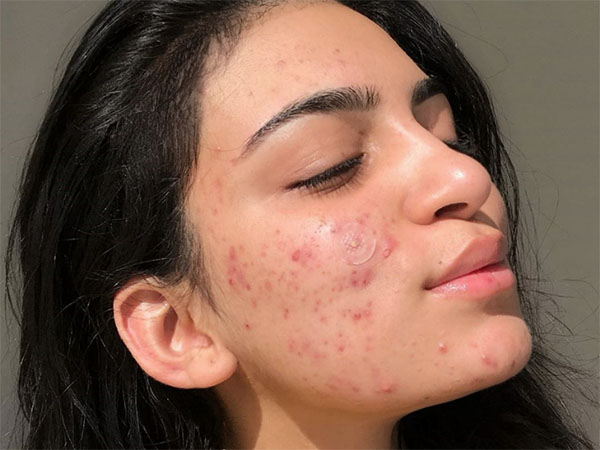 Mụn có thể gây ảnh hưởng đến ngoại hình của mọi người và cứ tái đi tái lại nhiều lần