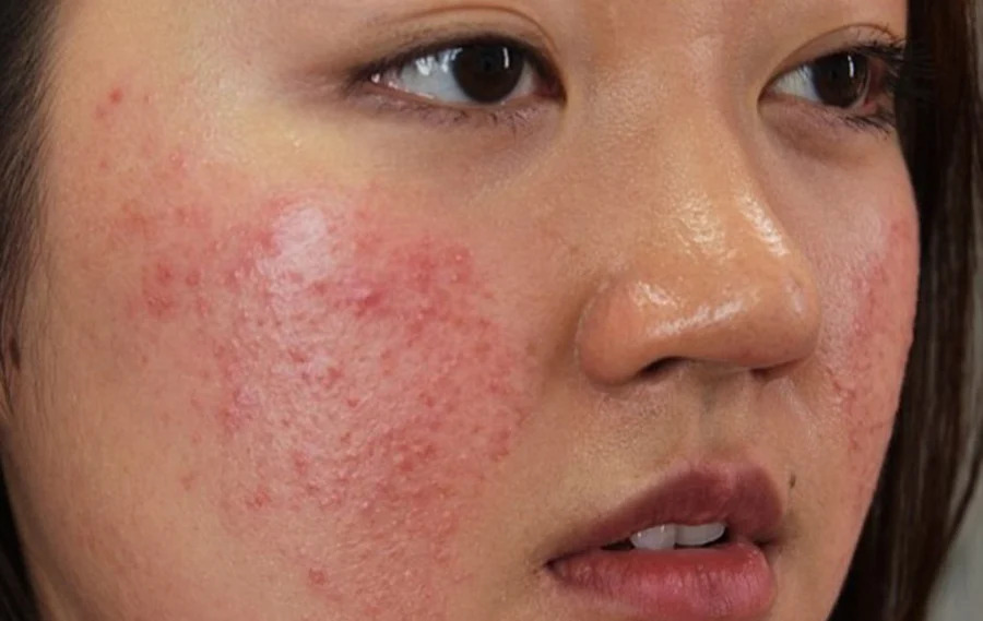 Da dầu thường là nguyên nhân chính gây ra mụn 