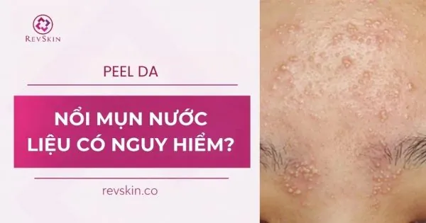 peel da nổi mụn nước nguy hiểm không