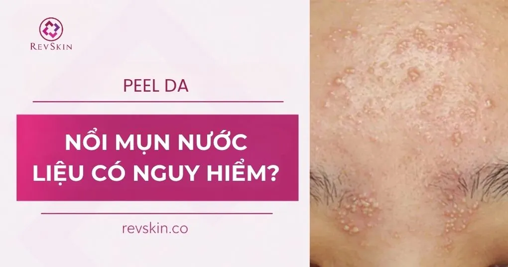 peel da nổi mụn nước nguy hiểm không